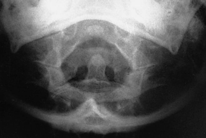 Proiezione di Fuchs: RX Cervicale Dente Epistrofeo