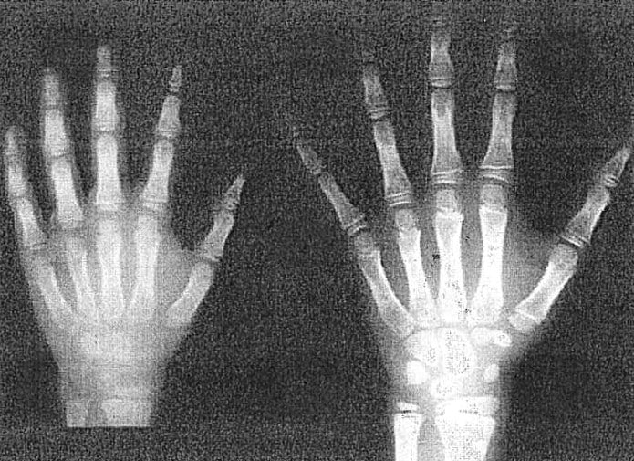 RX Polso: età ossea confronto radiografie