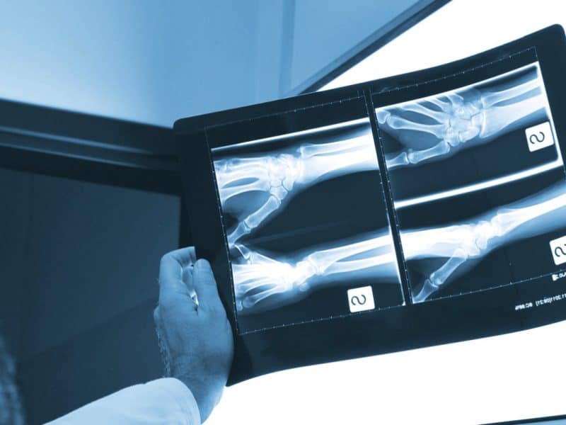 Rx Polso: come si fa la radiografia al polso