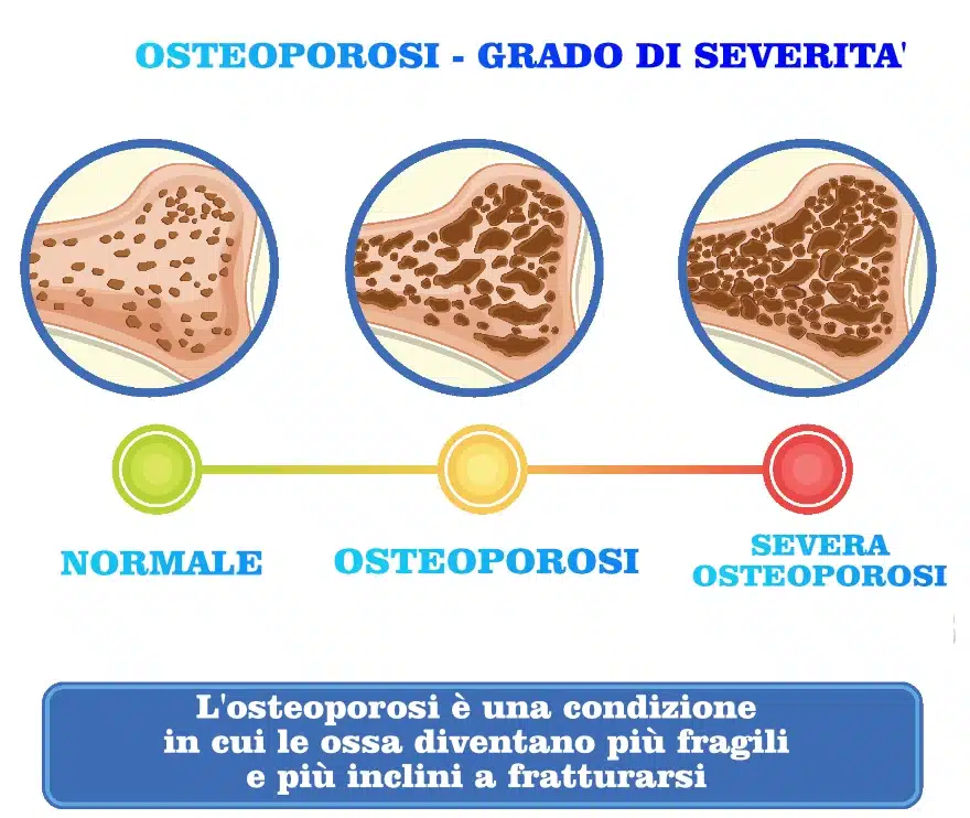 Grado di severità osteoporosi