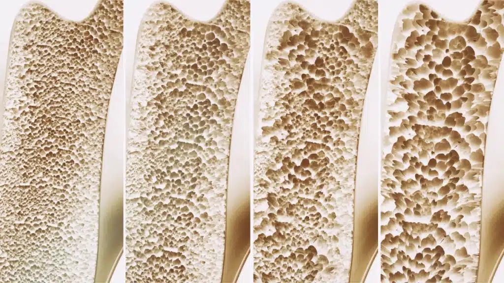 Degrado osseo con osteoporosi