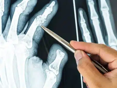 Radiografia della mano con osteoporosi