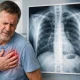 Dolore al torace: Quando far una radiografia